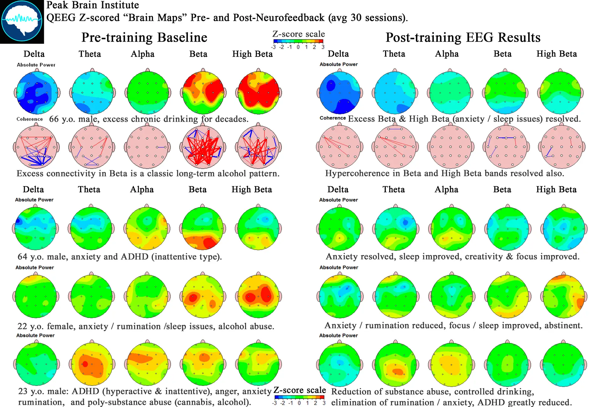 Pre-Post QEEG Examples