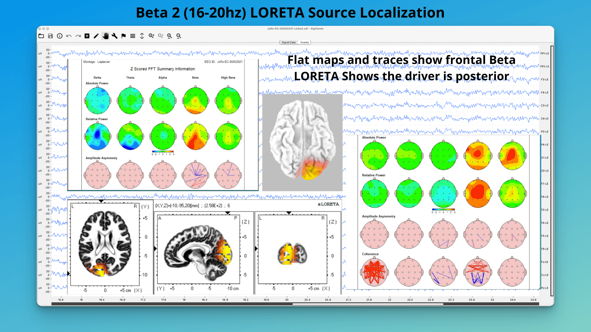How to use LORETA EEG Source Localization to Understand QEEG