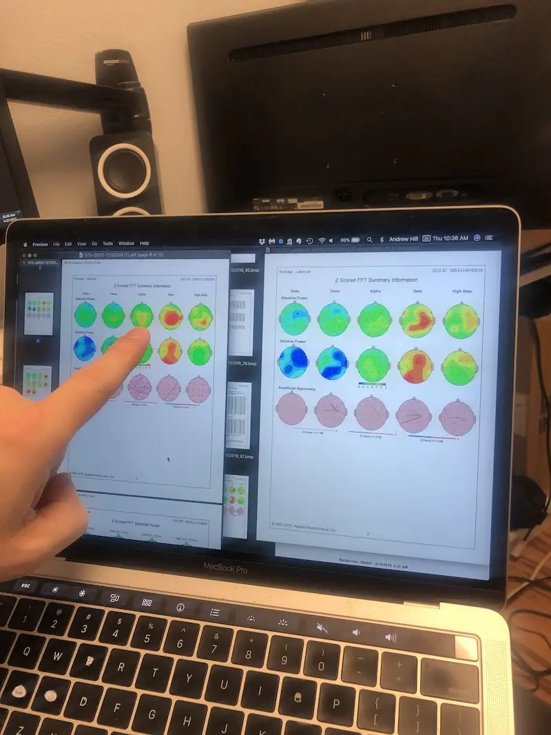 Neurofeedback vs Medication: The Astonishing Story of How Neurofeedback Cured My ADHD Without Medication